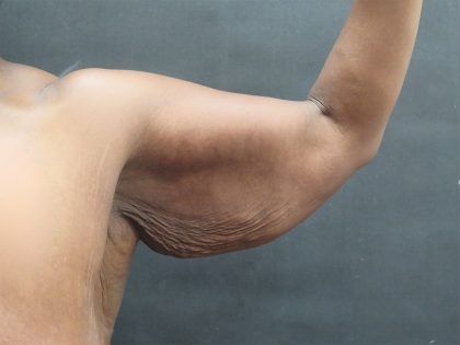 Arm Lift Before & After Patient #10811