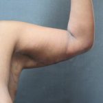 Arm Lift Before & After Patient #10811