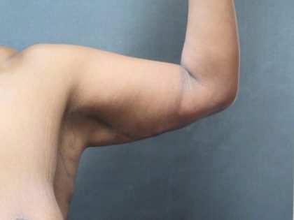 Arm Lift Before & After Patient #10811