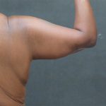 Arm Lift Before & After Patient #10811