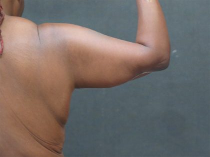 Arm Lift Before & After Patient #10811