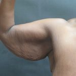 Arm Lift Before & After Patient #10811