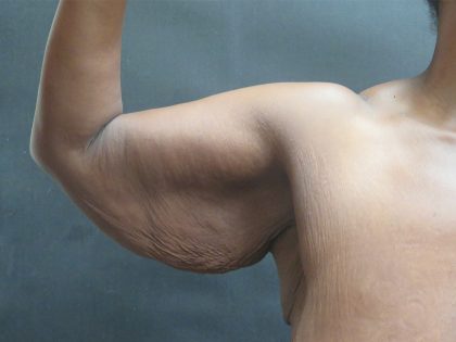 Arm Lift Before & After Patient #10811