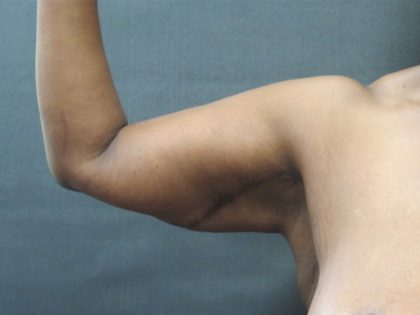 Arm Lift Before & After Patient #10811