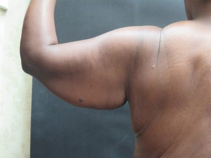 Arm Lift Before & After Patient #10811