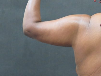 Arm Lift Before & After Patient #10811