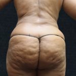 Liposuction Before & After Patient #11550