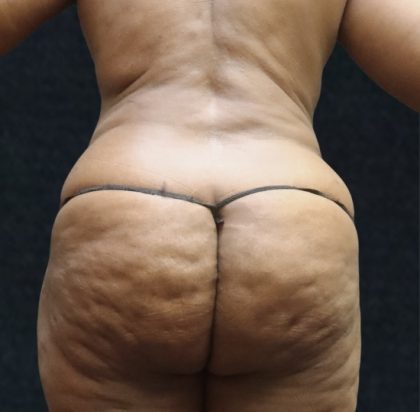 Liposuction Before & After Patient #11550