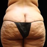 Liposuction Before & After Patient #11551