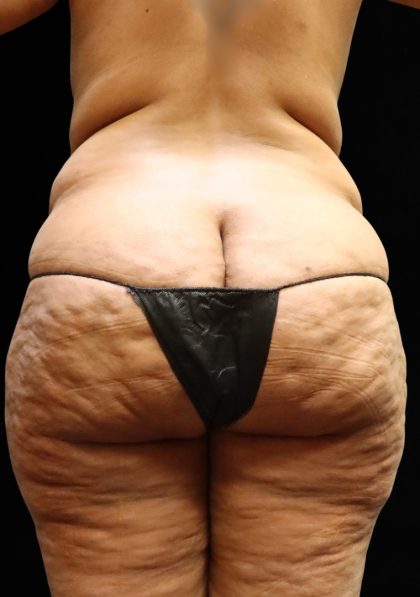 Liposuction Before & After Patient #11551