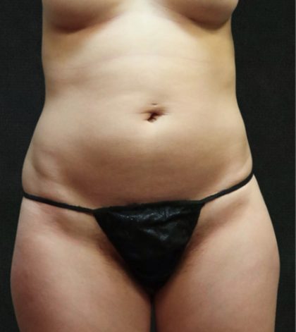 Liposuction Before & After Patient #11552