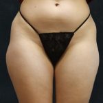 Liposuction Before & After Patient #11553