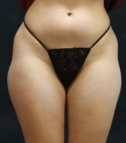 Liposuction Before & After Patient #11553