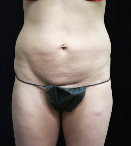 Liposuction Before & After Patient #11554