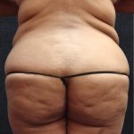 Liposuction Before & After Patient #11555