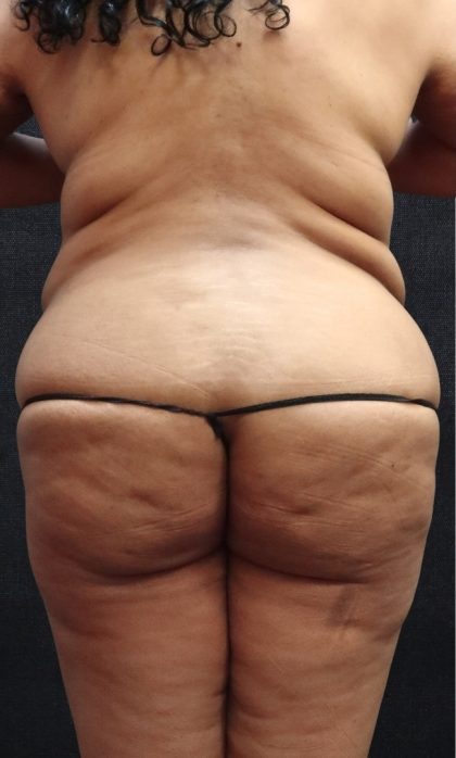 Liposuction Before & After Patient #11555