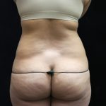 Liposuction Before & After Patient #11540