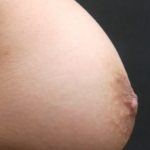 Inverted Nipple Correction Before & After Patient #11633