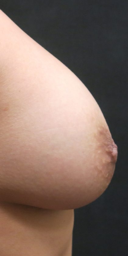 Inverted Nipple Correction Before & After Patient #11633