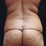 Liposuction Before & After Patient #11542