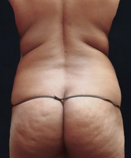 Liposuction Before & After Patient #11542