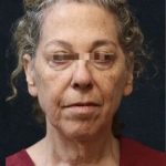 Facelift Before & After Patient #11659