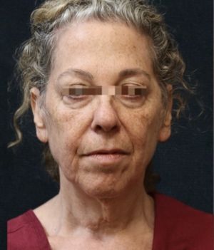 Facelift Before & After Patient #11659
