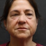 Facelift Before & After Patient #11660