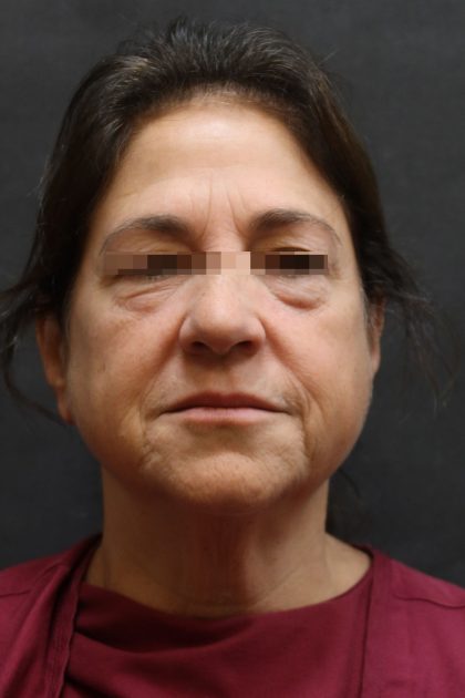 Facelift Before & After Patient #11660
