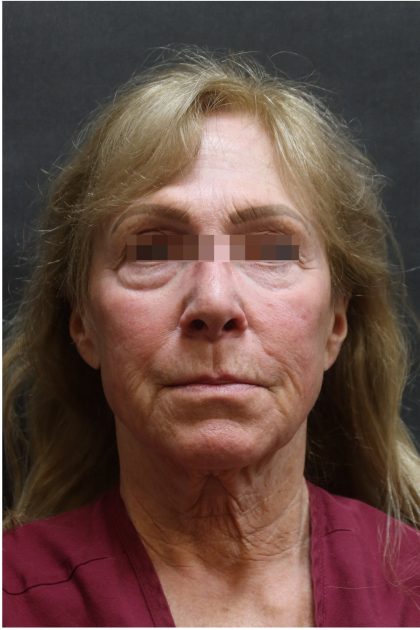 Facelift Before & After Patient #11662