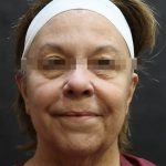 Facelift Before & After Patient #11663