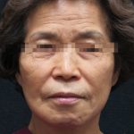 Facelift Before & After Patient #11664