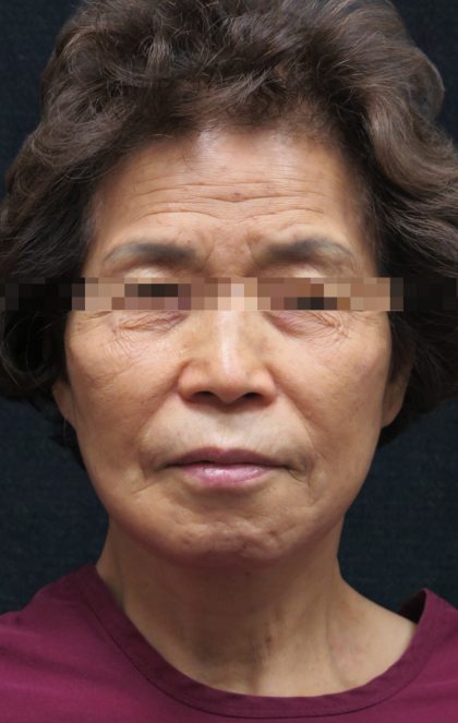 Facelift Before & After Patient #11664