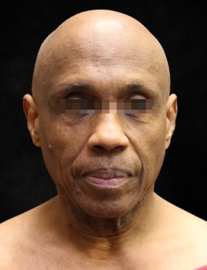 Facelift Before & After Patient #11665