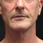 Facelift Before & After Patient #11666