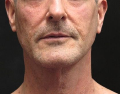 Facelift Before & After Patient #11666