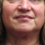Facelift Before & After Patient #11667