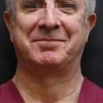 Facelift Before & After Patient #11669