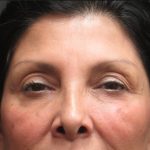 Browlift Before & After Patient #11766