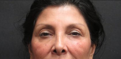 Browlift Before & After Patient #11766