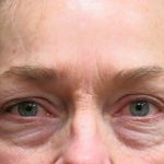 Browlift Before & After Patient #11767