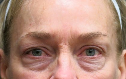 Browlift Before & After Patient #11767