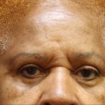 Browlift Before & After Patient #11768