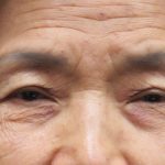 Browlift Before & After Patient #11769