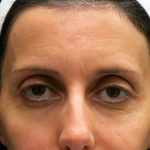 Browlift Before & After Patient #11771