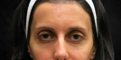 Browlift Before & After Patient #11771