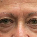 Browlift Before & After Patient #11772