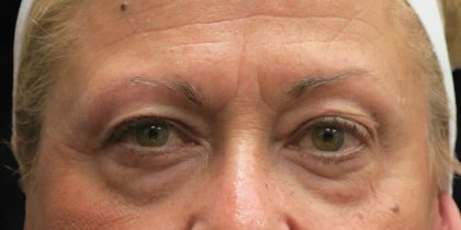 Browlift Before & After Patient #11772