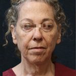 Levinelift Before & After Patient #11787