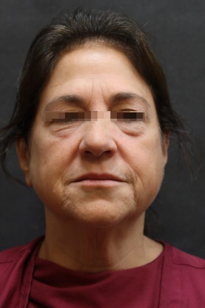 Levinelift Before & After Patient #11788